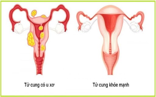 Bệnh u xơ cổ tử cung khá phổ biến ở phụ nữ
